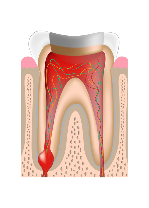 歯の神経の除去