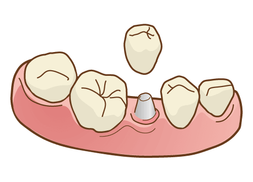 インプラントオーバーデンチャー
