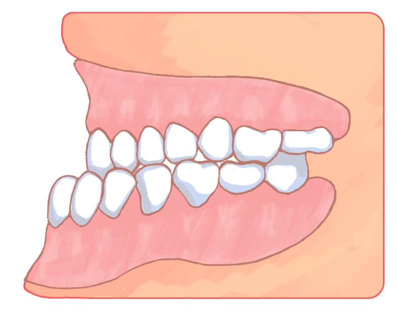 下顎前突(かがくぜんとつ)