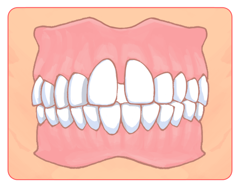 空隙歯列（くうげきしれつ）
