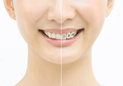 歯科矯正でも目立ちにくい、新しい矯正方法